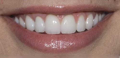 After Philips Zoom! Whitening